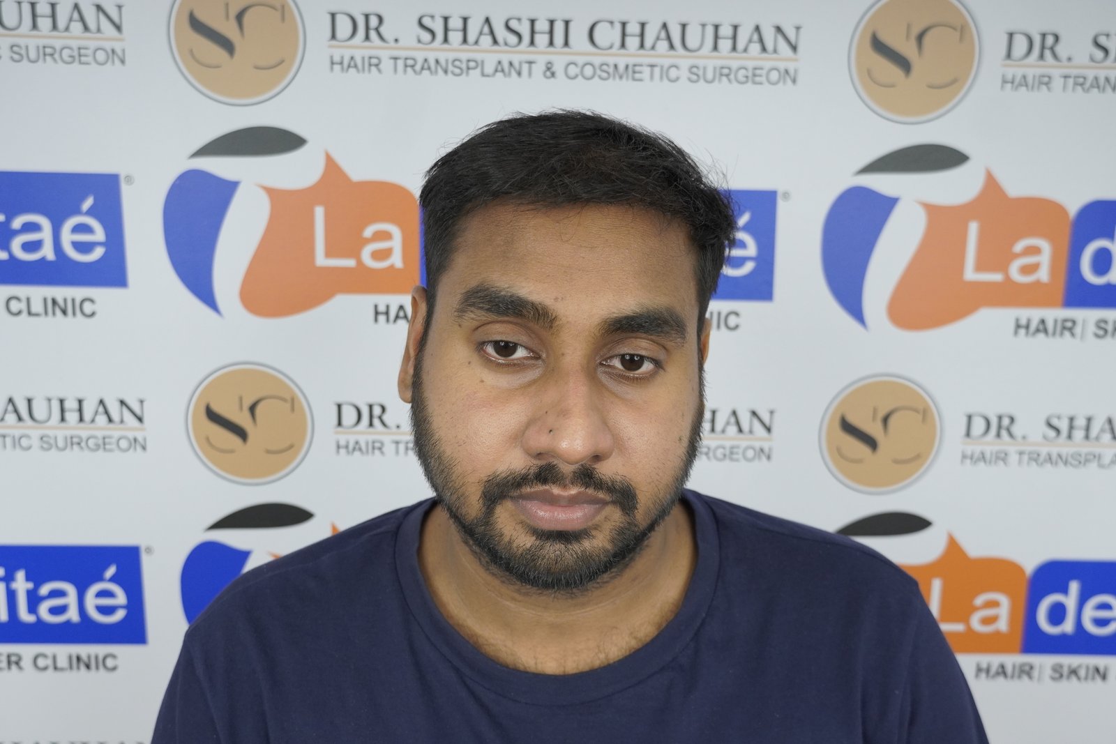 Shreyankar Maurya After Hair Transplant